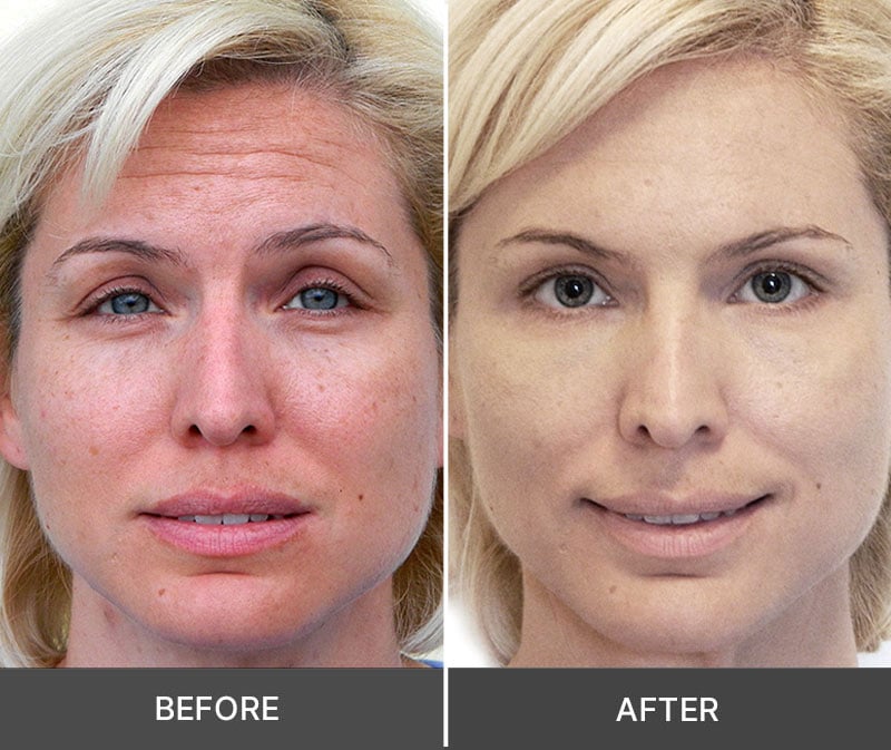 Idrotherapy results before and after